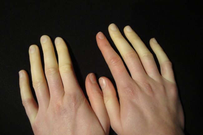 Barevné změny na prstech