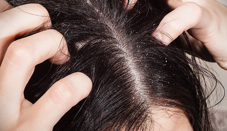 Proč vznikají lupy ve vlasech a jak zvládnout problémy s lupy