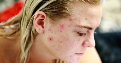 Top 3 domácí léčebné prostředky k léčbě růžovky (Rosacea)