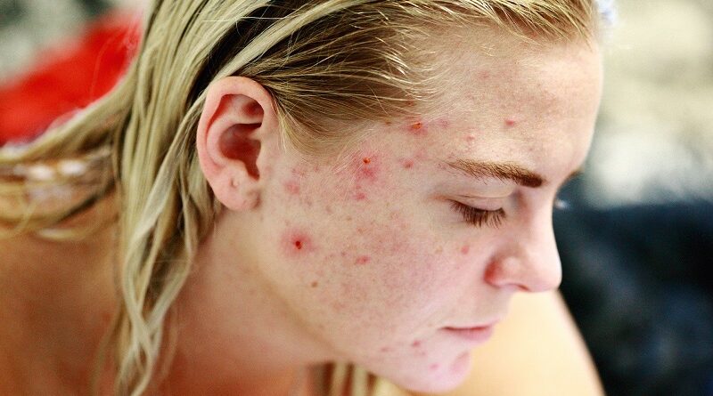 Top 3 domácí léčebné prostředky k léčbě růžovky (Rosacea)